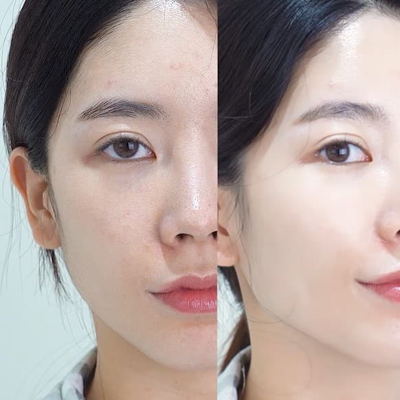 【hamel(ハメル)】トックスアンプルスティック マルチバーム使用時、使用後比較